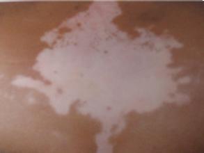 白癜风疾病难以治疗的原因是什么 白癜风疾病难以治疗的原因是什么