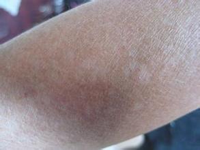 预防白癜风有哪些具体措施 预防白癜风有哪些具体措施.jpg