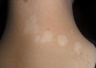 白癜风症状有哪些 对于身体有什么样的危害 白癜风症状有哪些 对于身体有什么样的危害