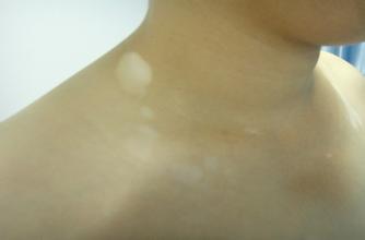 黑色素细胞种植术的效果好不好呢 黑色素细胞种植术的效果好不好呢.jpg