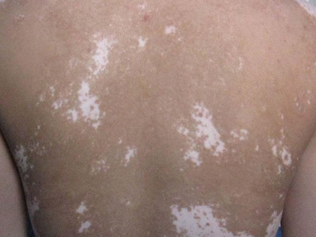 醋能治疗白癜风是真的吗 醋能治疗白癜风是真的吗.jpg