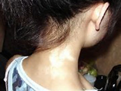 白癜风心理治疗方法 白癜风心理治疗方法