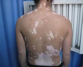 讲述儿童白癜风的病因 讲述儿童白癜风的病因.jpg