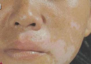 白癜风穿衣需要注意哪些事项 白癜风穿衣需要注意哪些事项