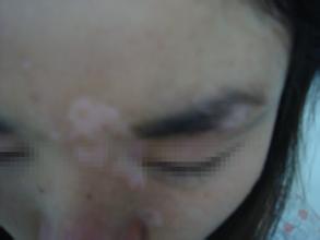 脸上长白癜风跟长期吃维生素C有关吗 脸上长白癜风跟长期吃维生素C有关吗.jpg