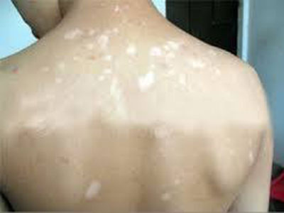 怎么控制白癜风扩散 怎么控制白癜风扩散