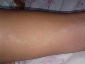 男性有白癜风怎么治疗 男性有白癜风怎么治疗.jpg