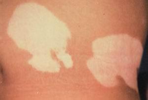 身体发现白斑的出现怎么办 身体发现白斑的出现怎么办.jpg