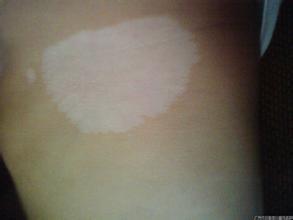 哪些因素容易导致肢端型白癜风 哪些因素容易导致肢端型白癜风.jpg