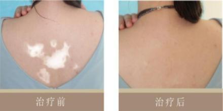 为何白癜风要抽血检查 为何白癜风要抽血检查.jpg