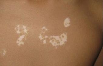 如何防止白癜风病情扩散 如何防止白癜风病情扩散.jpg