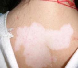 怎么预防白癜风疾病扩散 怎么预防白癜风疾病扩散.jpg