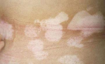 老年白癜风的症状特点有哪些 老年白癜风的症状特点有哪些