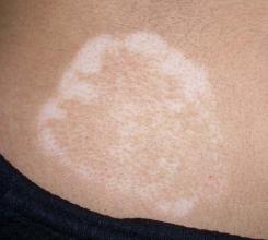 白癞风初期都长在什么位置 白癞风初期都长在什么位置.jpg