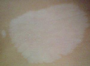 患上了白癜风症状特点都有哪些呢 患上了白癜风症状特点都有哪些呢