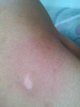 哪些是治疗白癜风的错误方法 哪些是治疗白癜风的错误方法.jpg