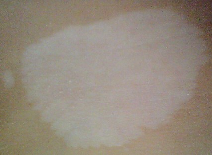 白癜风的前期症状能够分为以下几点 白癜风的前期症状能够分为以下几点.jpg