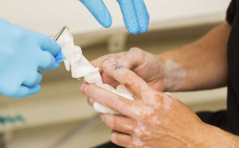 怎么知道得白癜风的原因 怎么知道得白癜风的原因