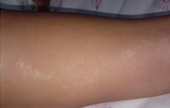 手上患发白癜风的原因有什么呢 手上患发白癜风的原因有什么呢.jpg